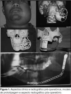 Ameloblastoma